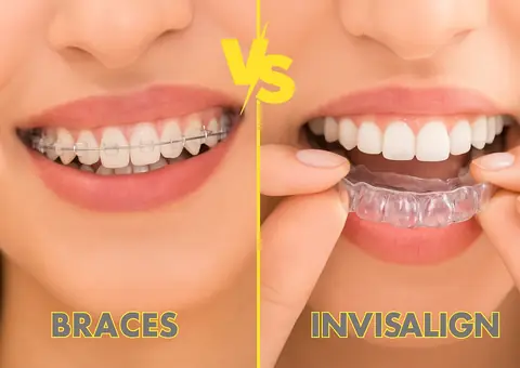 Dental implant before and after result at AB’S Dental Guntur