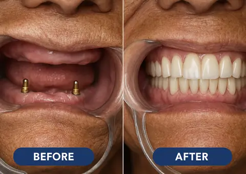 Full mouth dental implants guide cover image